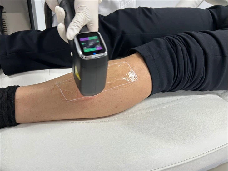 High Energy Diode Laser Hair Removal