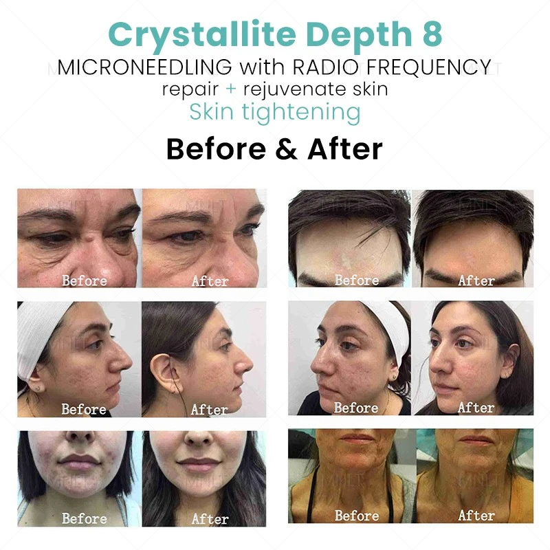 Crystallite Depth 8 Skin Rejuvenation Machine – Advanced Microchannel Technology For Professional Aesthetic Clinics high quality