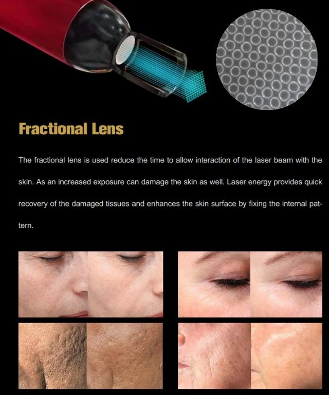 Portable Tattoo Removal Machine
