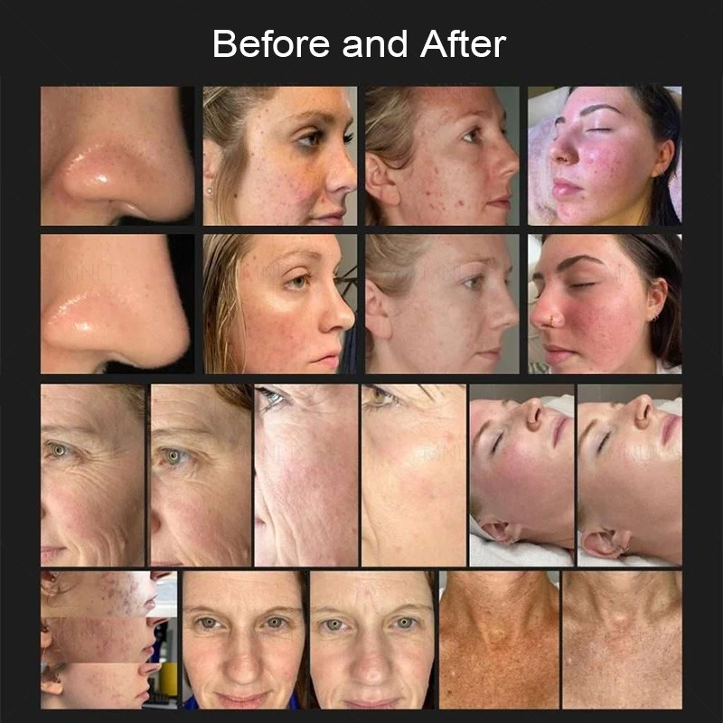Revolutionary Cold Plasma High-Frequency Beauty Device: The Future Of Aesthetic Innovation suppliers